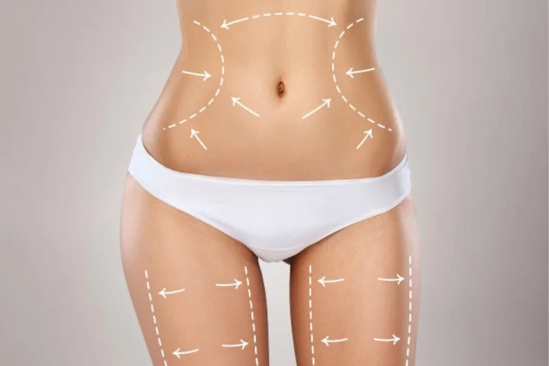 Non-surgical body contouring treatment areas
