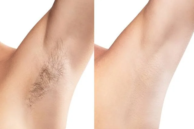 Diode laser hair removal before and after illustration