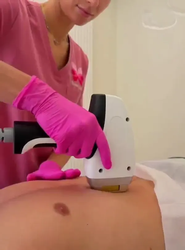 BioSkin Laser gallery video 5 preview