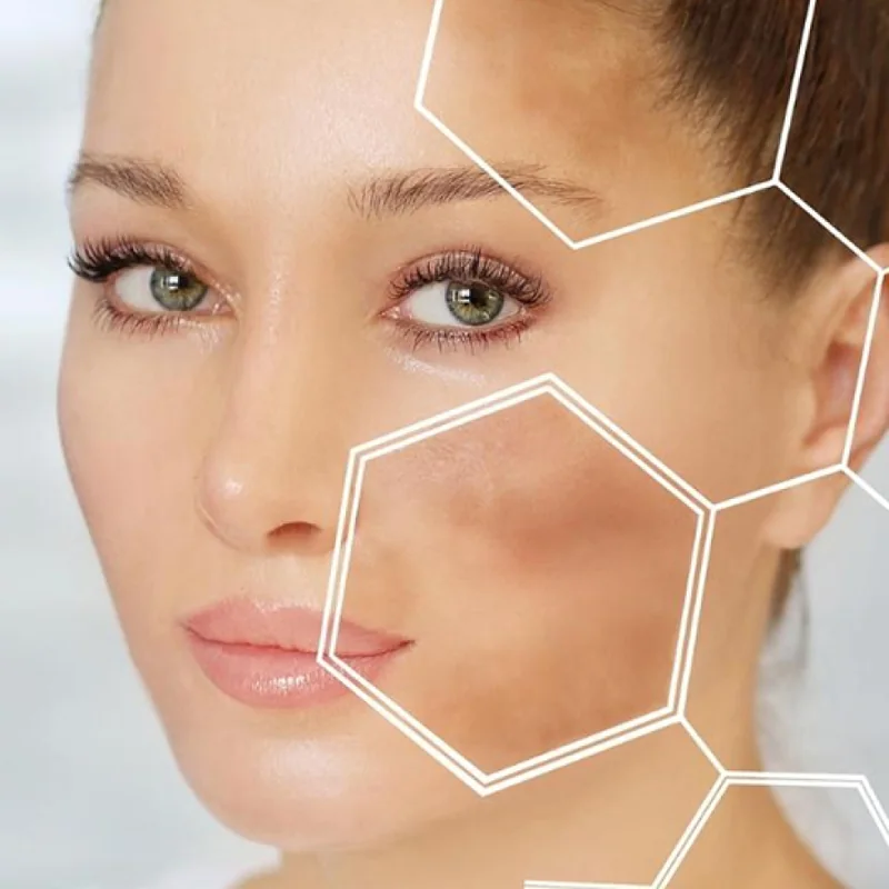 Melasma and facial pigmentation skincare illustration