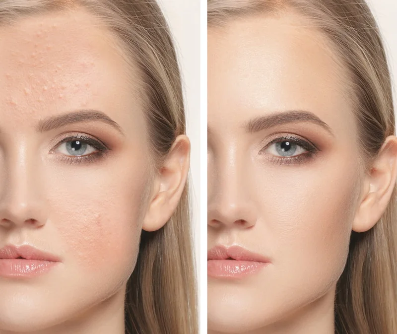 RF Pixel resurfacing and RF microneedling skincare illustration